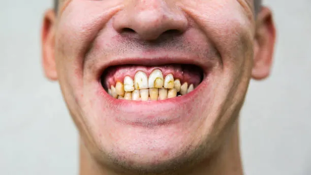 Dientes dañados y obturaciones deficientes antes del tratamiento