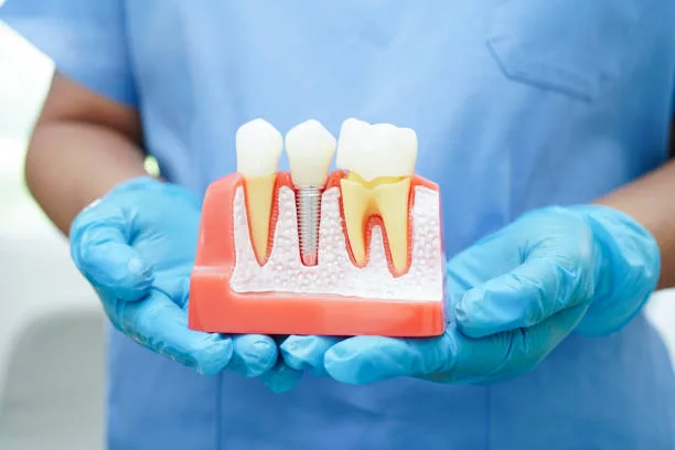 Odontólogo mostrando un implante dental a un paciente