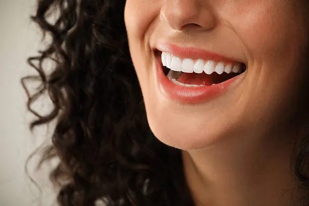 Sonrisa con carillas de porcelana después del tratamiento